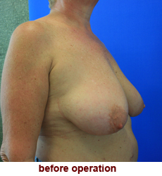 plastic-surgery-breast-lift-augmentation